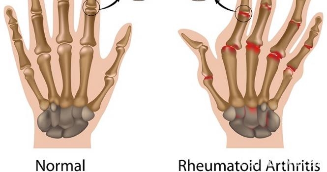 autoimuni liječenje artritisa